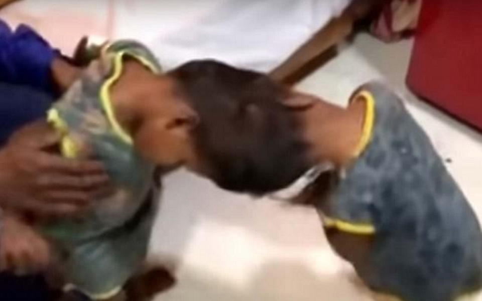 Gemelle sianesi attaccate dalla testa, separati dopo operazione di 20 ore