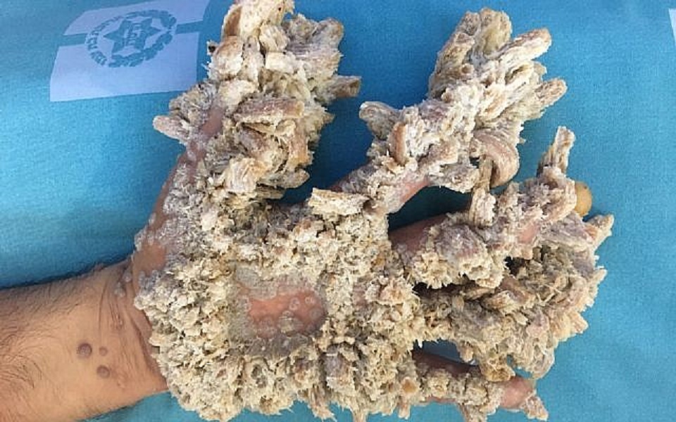 Soffre della sindrome da uomo albero e per 10 anni non esce di casa