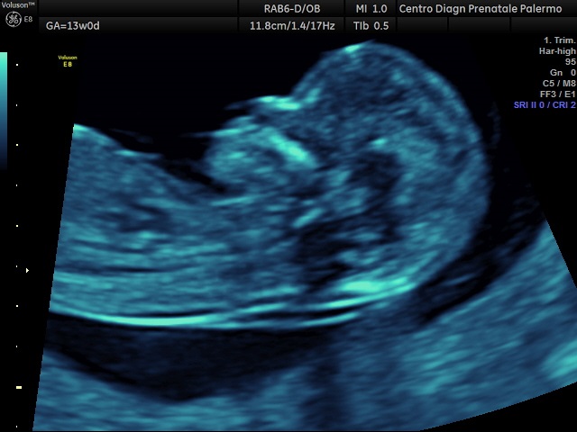 Islanda, non nascono più bambini con la sindrome di Down. Merito dello screening pre-natale