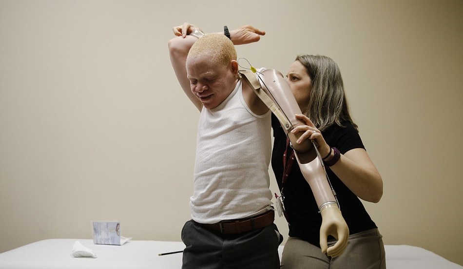 Bambini albini mutilati in Tanzania: grazie alle protesi Usa tornano a sperare