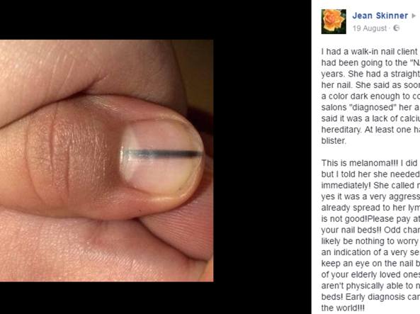 Riga nera sotto l'unghia, viene salvata dall'estetista: era melanoma