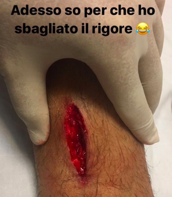 Diego Perotti, foto: ecco perché ho sbagliato il rigore. Taglio alla caviglia destra