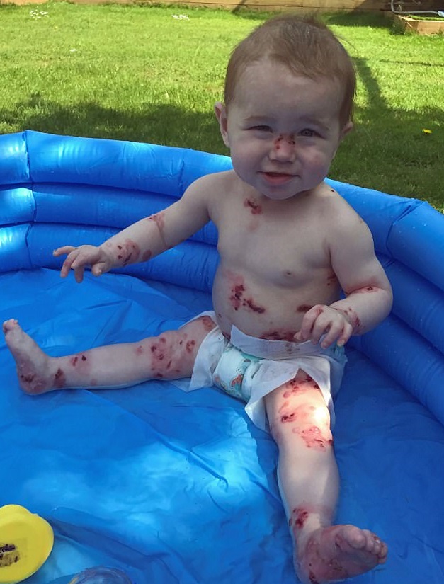 Pippa ha un anno e soffre di epidermolisi bollosa