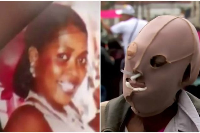 Papa alla donna sfigurata: "Sei coraggiosa e bella". E lei decide di non ricorrere più all'eutanasia