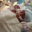 Cincinnati, nati gemelli siamesi inoperabili. I genitori non hanno voluto abortire01