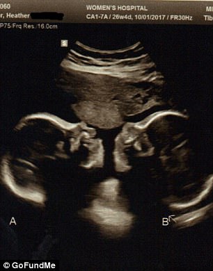 Cincinnati, nati gemelli siamesi inoperabili. I genitori non hanno voluto abortire03