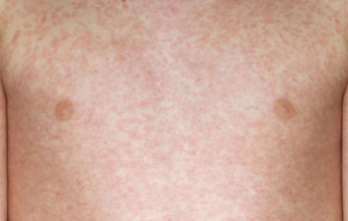 Morbillo party per i bambini. Gli untori dei bacilli che chiamano santi