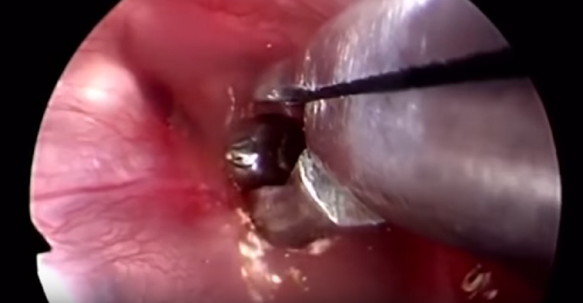 Rimuovono zecca dall'orecchio del paziente: il parassita resiste, i medici faticano