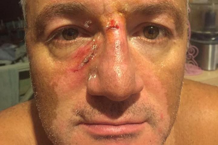 Napoli, si rifiuta di pagare il parcheggiatore abusivo: preso a pugni