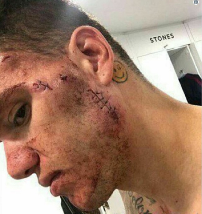 Fallo killer di Mané su Ederson: come è ridotta la faccia del portiere FOTO