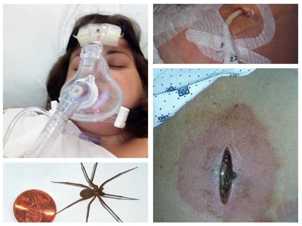 Puntura nel sonno, credeva fosse una zanzara, ma era un ragno velenoso: è in fin di vita02