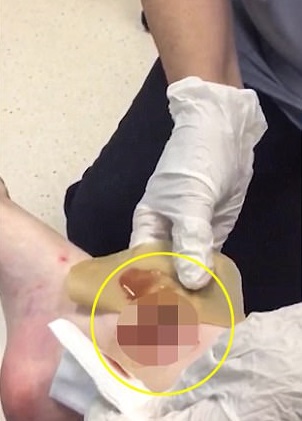 YOUTUBE Gran Bretagna, morsa da ragno nella sua camera: ecco cosa le provoca il veleno