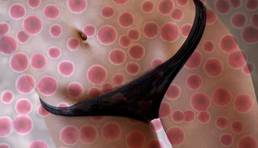 malattie-veneree-boom-giovani