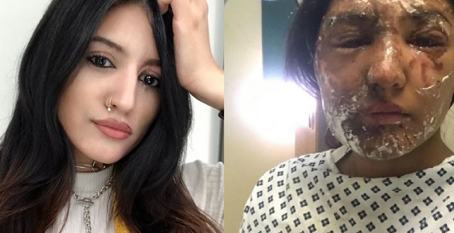 modella-sfregiata-acido