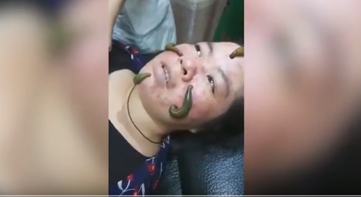 sanguisughe-viso-cina