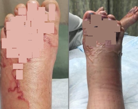 Vacanza Caraibi larve migrans