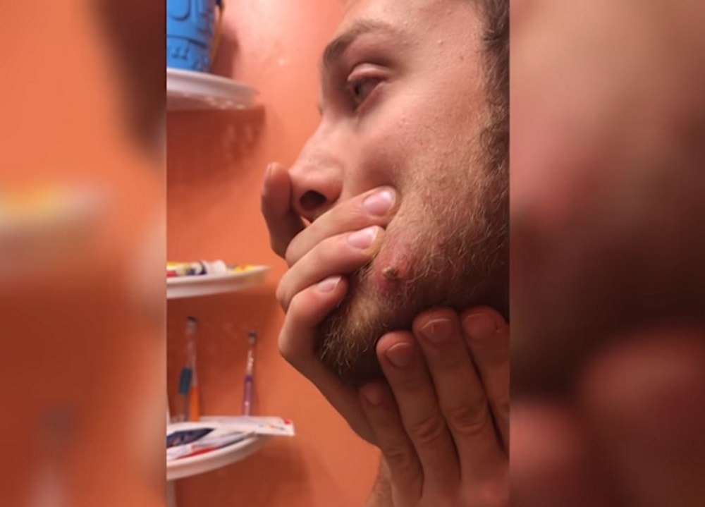 YOUTUBE Cisti sulla guancia: Frederic la preme e quello che esce è disgustoso