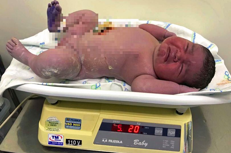 Neonata dal peso record in Brasile: quasi 6 kg