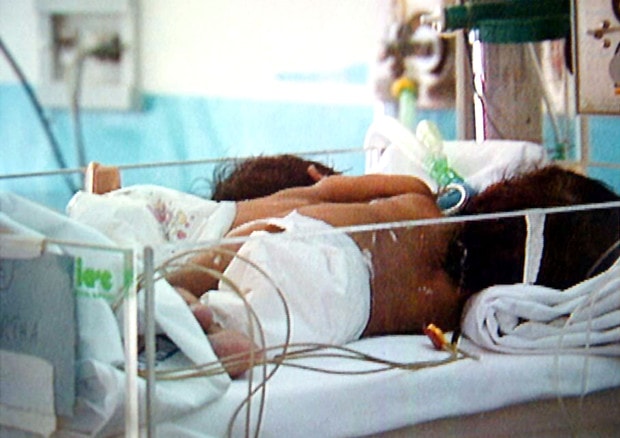 Condividevano fegato e intestino: separate gemelle siamesi a Bergamo