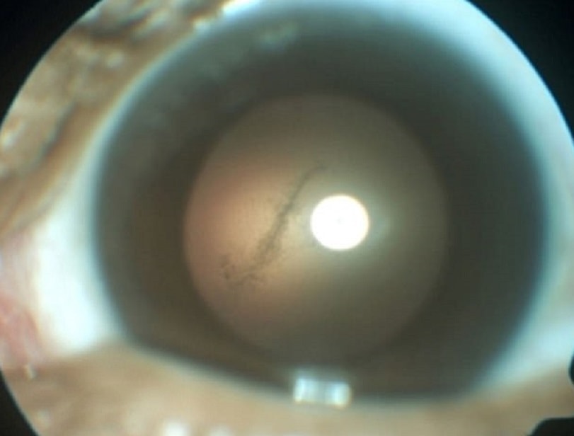 La tenia nell'occhio