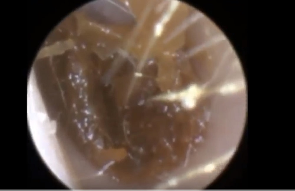Tappo di cerume rimosso dall'orecchio del paziente