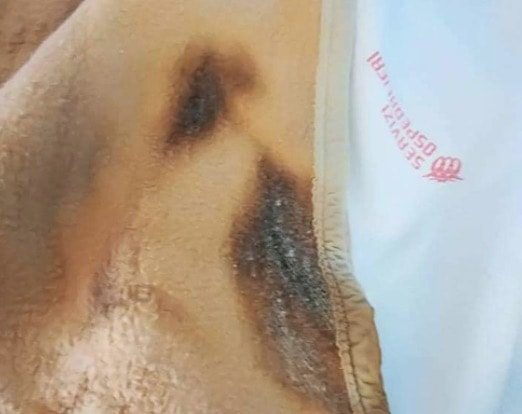 In ospedale a Osimo una coperta sporca e bruciata per un anziano paziente