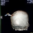 Il cranio mostra chiaramente la chiave conficcata nella testa