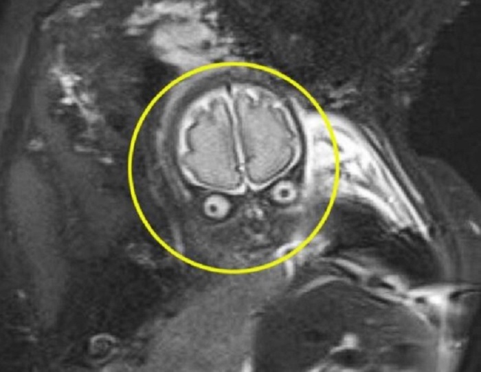 "Mio figlio è un alieno": curiosa ecografia di un bimbo alla 30esima settimana