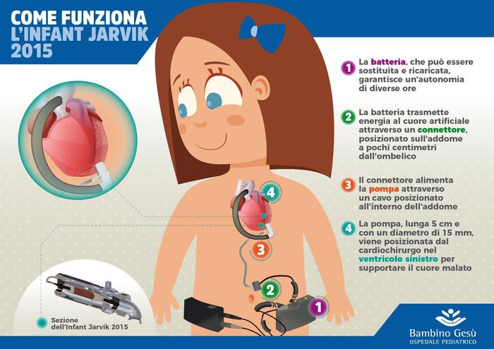 Bambino Gesù: mini cuore artificiale grande come una batteria stilo salva bimba in attesa del trapianto