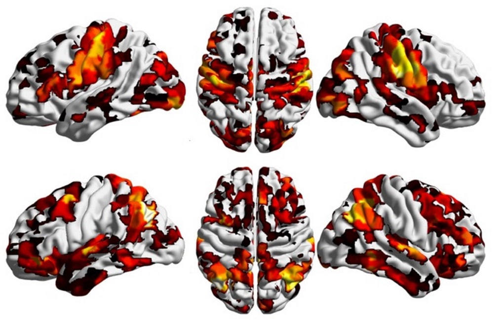 Scoperta la culla della schizofrenia nel cervello