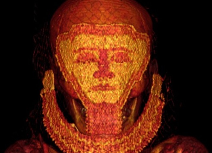 Pisa, scoperto un tumore osseo di mille anni fa su uno scheletro medievale (foto d'archivio)