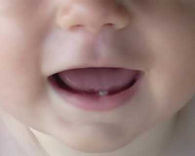 dentini bimbo benzocaina