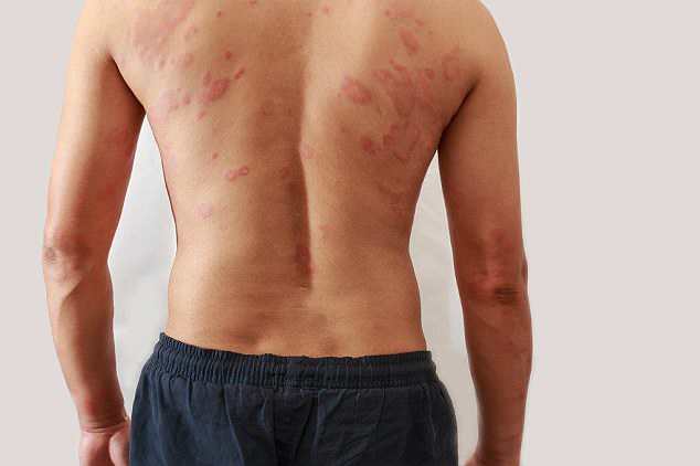 eczema cuore