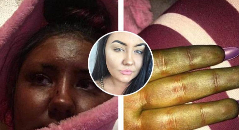 Usa una crema abbronzante di bassa qualità e finisce malissimo: "Somiglio s Shrek"