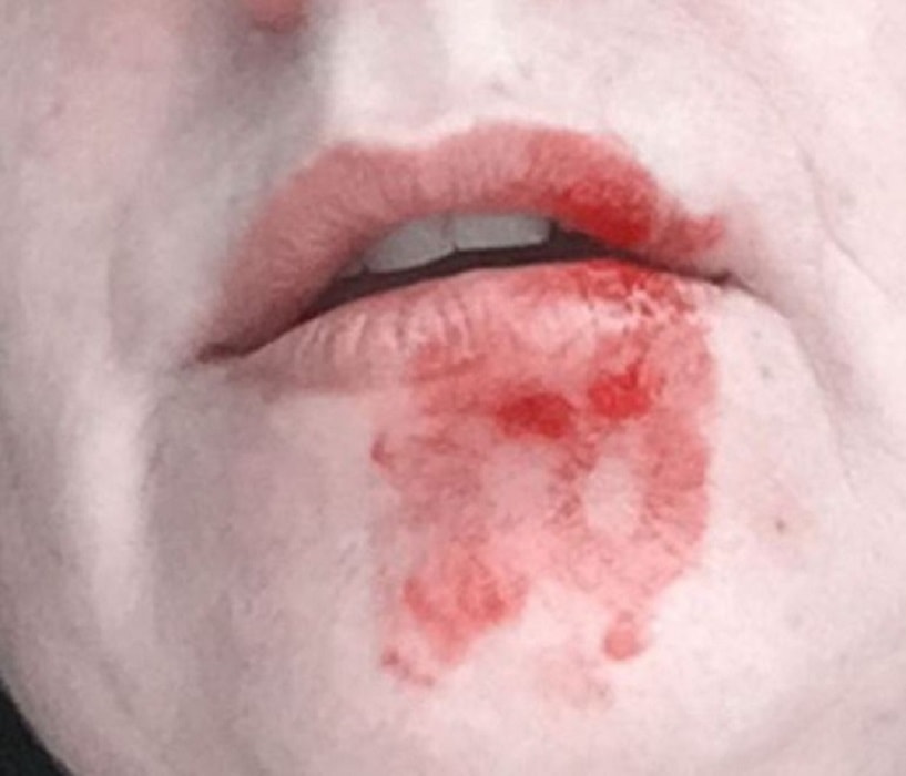 Labbro sfregiato donna venezia da gabbiano