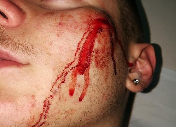 Napoli, 16enne picchiato e aggredito da una baby gang a Scampia