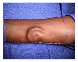 L'orecchio sul braccio: l'hanno fatto crescere lì prima di impiantarglielo in testa