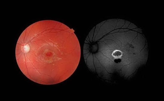 Retina bruciata con puntatore laser