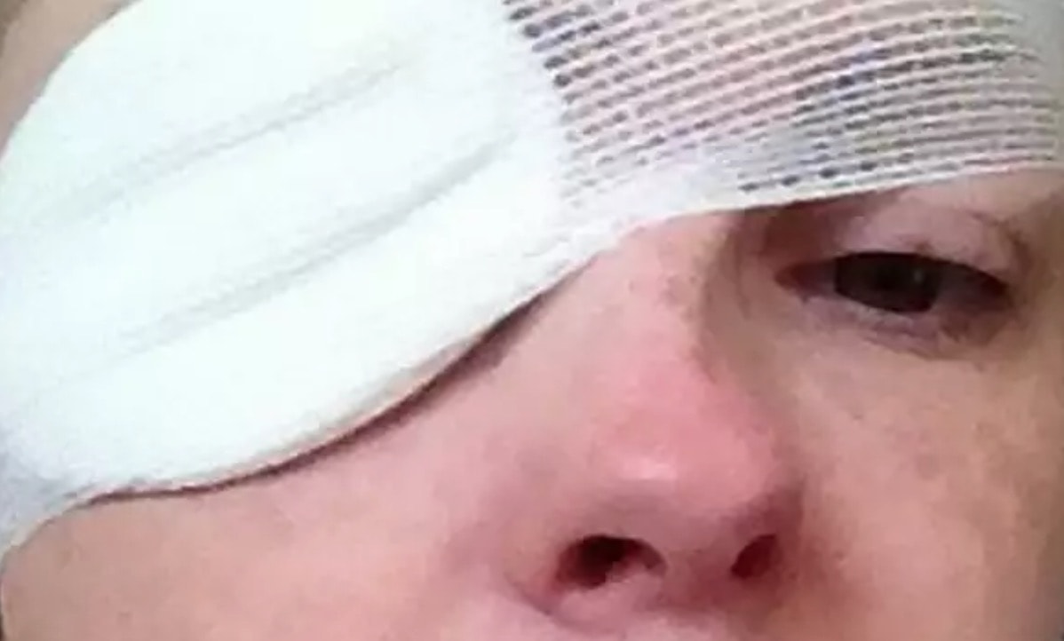 Malattia di Lyme: zecca la morde al collo, resta con il volto paralizzato