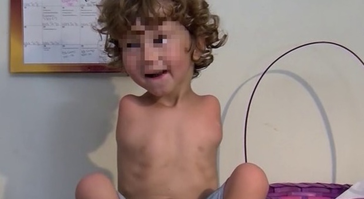 Il piccolo William non ha le braccia e mangia coi piedi: cacciato dal ristorante. "Non è igienico"