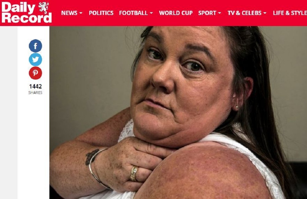 Va in vacanza in hotel di lusso: si sveglia divorata dalle cimici