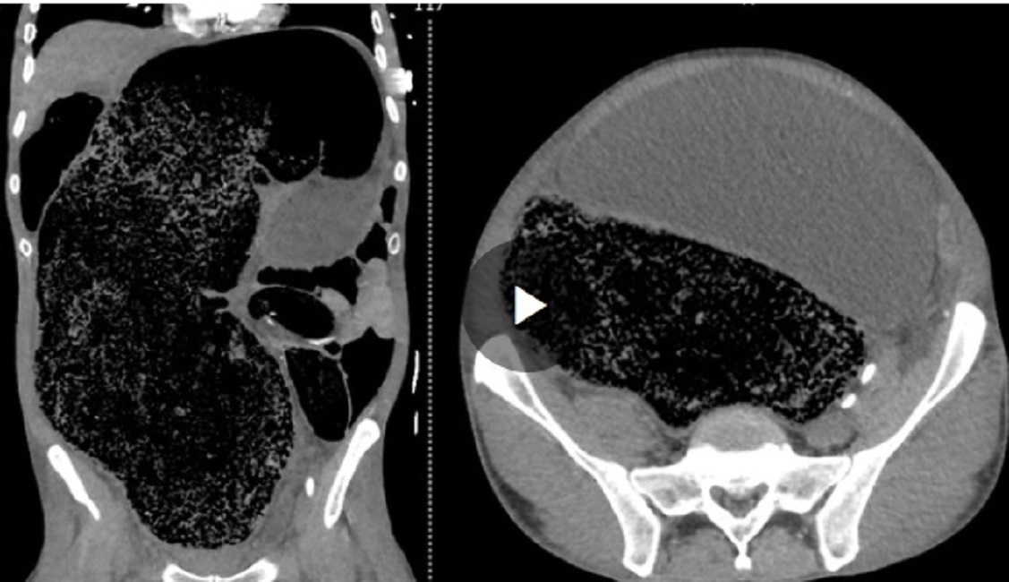 Non va in bagno per 3 giorni e rischia di morire: medici gli rimuovono 2 litri di feci