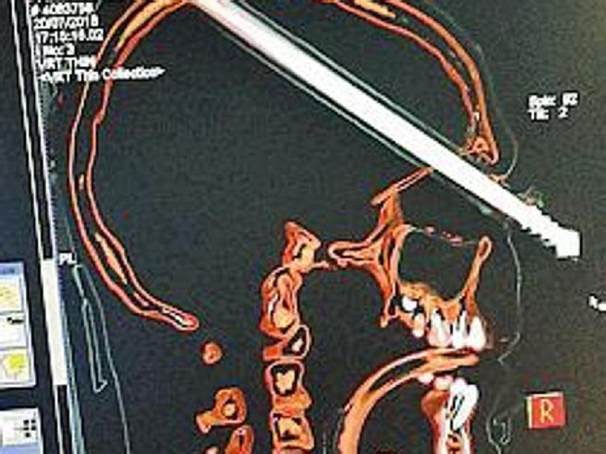 Sperlonga, ragazzino inglese di 14 anni si spara in faccia con la fiocina. Non perderà la vista