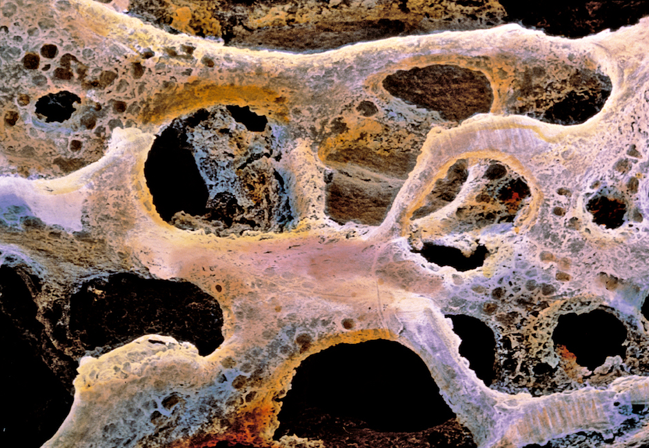 Osteoporosi, la dieta mediterranea riduce il rischio di frattura dell'anca