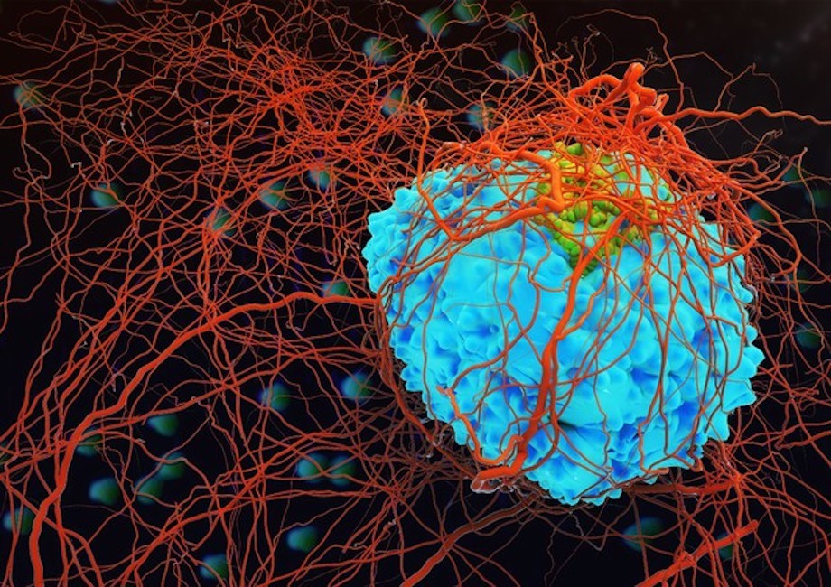 Car-T, ok della Ue alla prima terapia con cellule del paziente addestrate a riconoscere tumori
