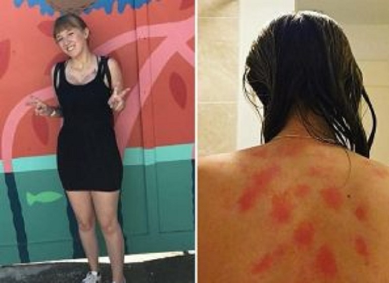 Lindsey Coubray, la diciannovenne allergica all'acqua