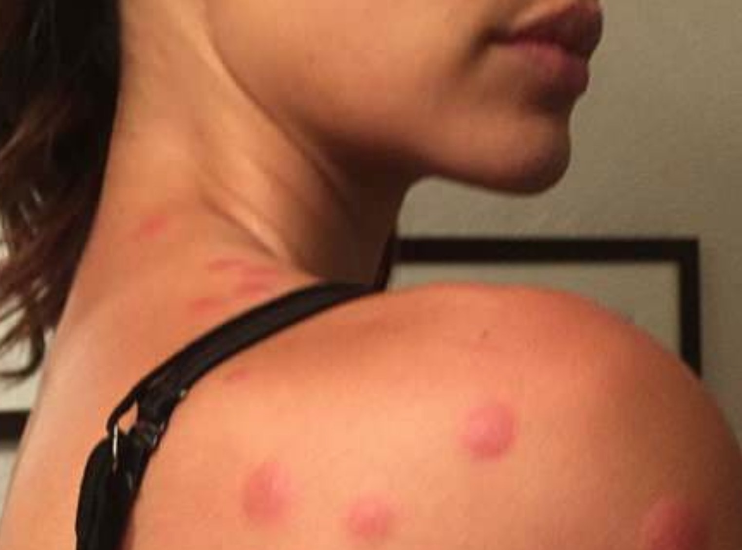 Modella Sabrina Jales all'hotel Embassy Suites by Hilton si sveglia coperta di morsi di cimici