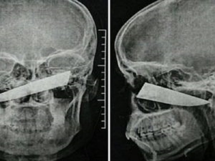 Coltello 10 cm trapassa faccia