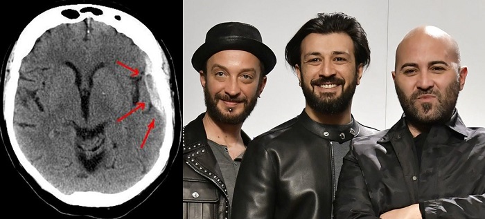 Emanuele Spedicato Ictus