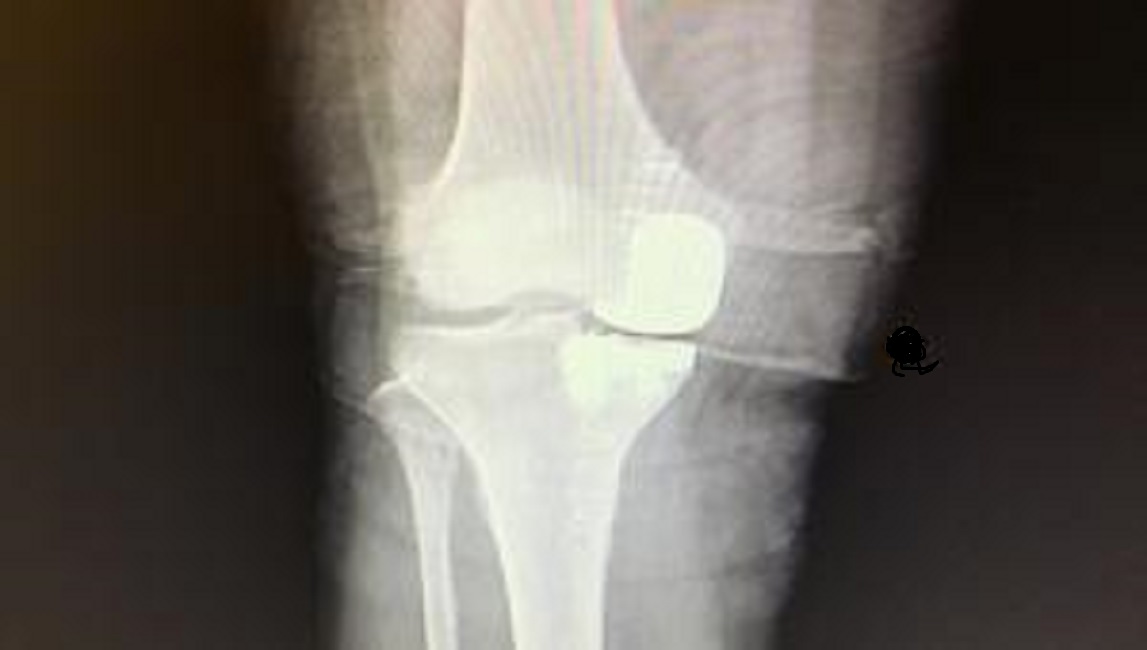 Stampati in 3D i primi tendini e legamenti umani